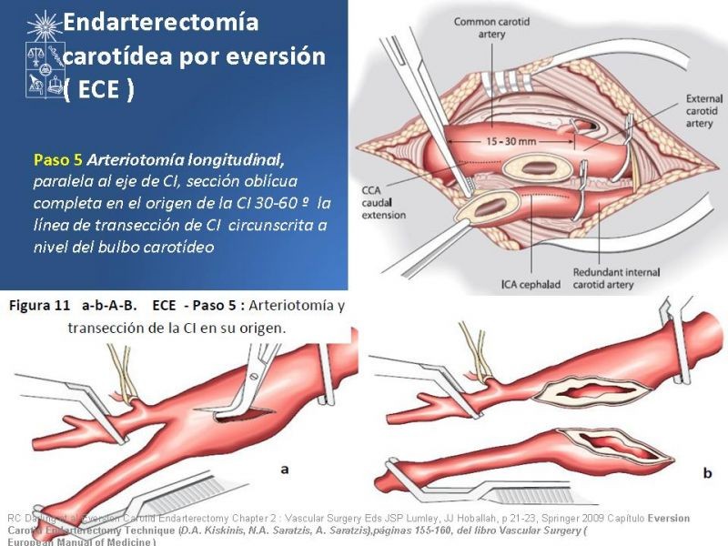 Diapositiva 48 de Manejo de pacientes con Enfermedad Carotídea Extracraneal Asintomáticos