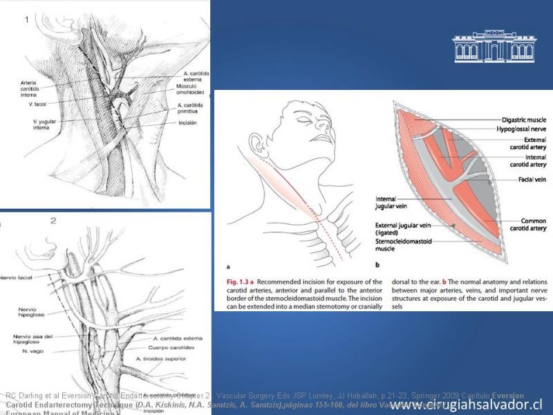 Diapositiva 36 de Manejo de pacientes con Enfermedad Carotídea Extracraneal Asintomáticos