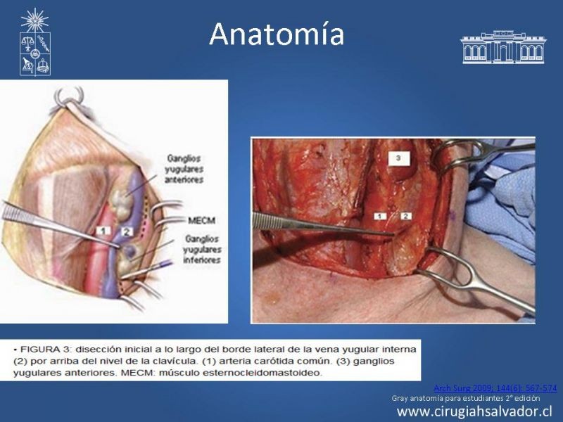 Diapositiva 5 de Manejo de pacientes con Enfermedad Carotídea Extracraneal Asintomáticos