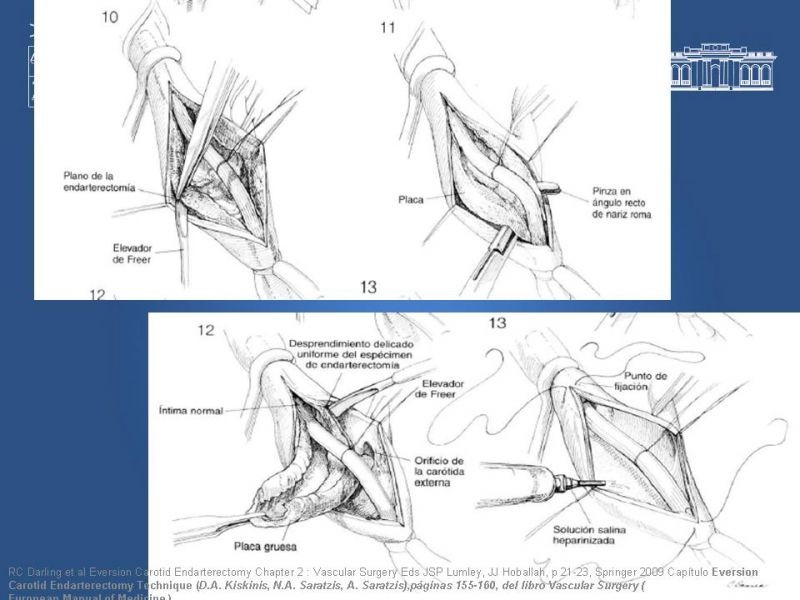 Diapositiva 42 de Manejo de pacientes con Enfermedad Carotídea Extracraneal Asintomáticos