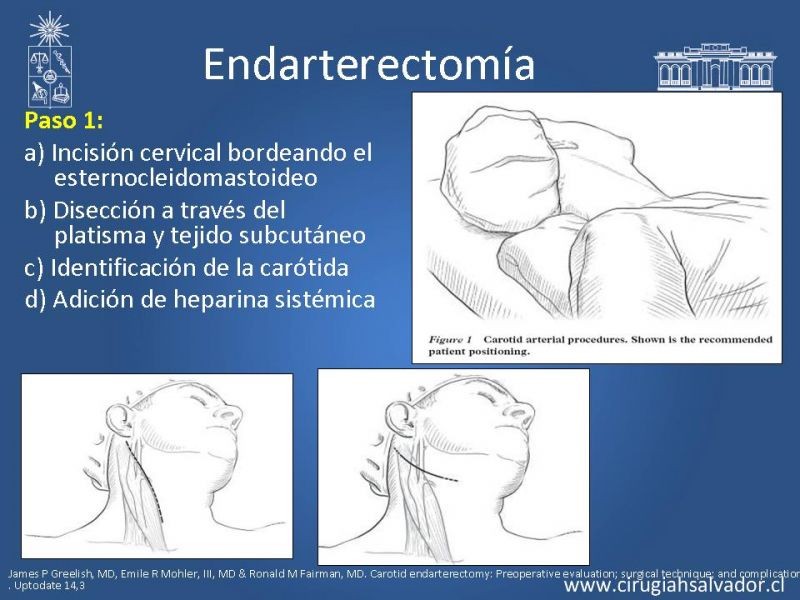 Diapositiva 35 de Manejo de pacientes con Enfermedad Carotídea Extracraneal Asintomáticos