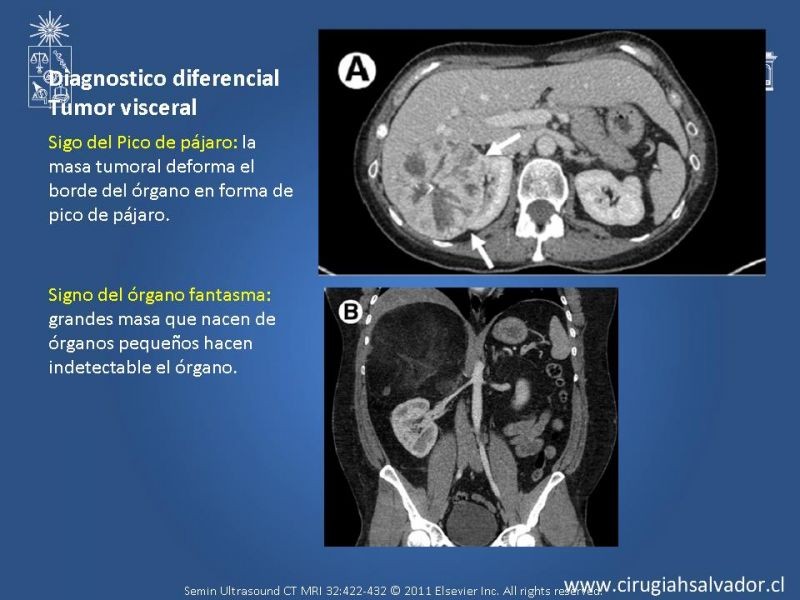Diapositiva 14 de Sarcoma retroperitoneal