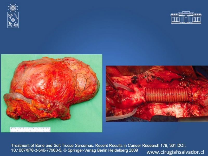 Diapositiva 19 de Sarcoma retroperitoneal