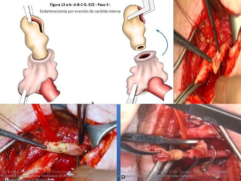 Diapositiva 50 de Manejo de pacientes con Enfermedad Carotídea Extracraneal Asintomáticos