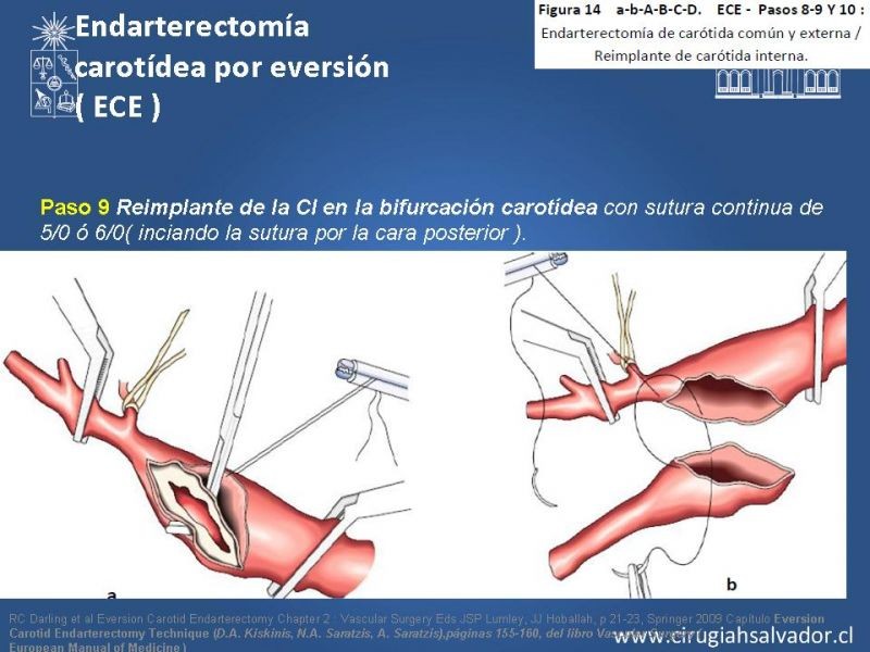 Diapositiva 51 de Manejo de pacientes con Enfermedad Carotídea Extracraneal Asintomáticos