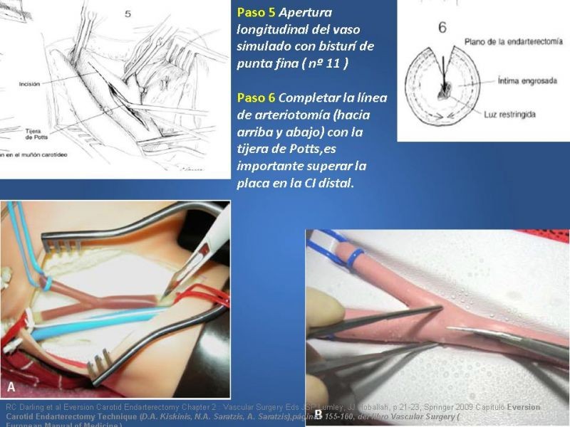 Diapositiva 38 de Manejo de pacientes con Enfermedad Carotídea Extracraneal Asintomáticos