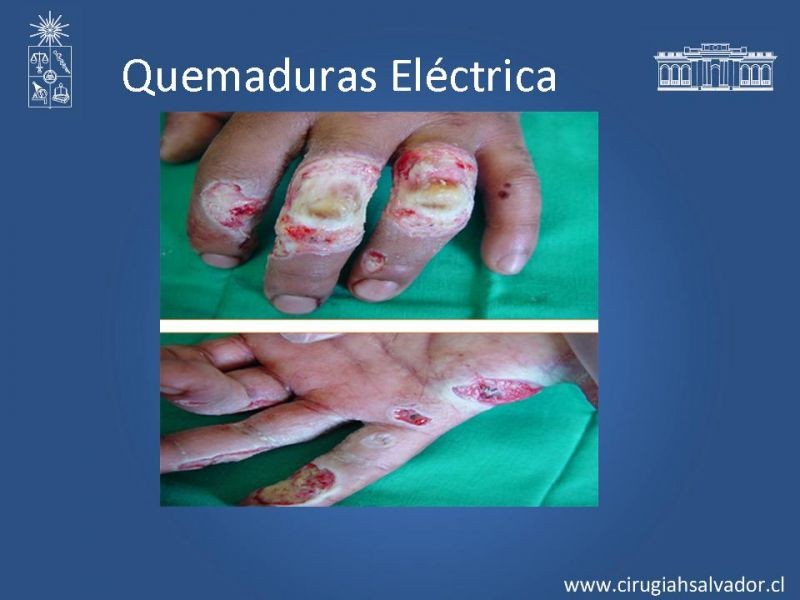 Diapositiva 17 de Quemaduras