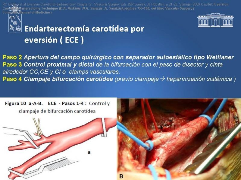 Diapositiva 47 de Manejo de pacientes con Enfermedad Carotídea Extracraneal Asintomáticos
