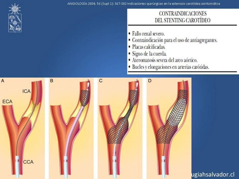 Diapositiva 61 de Manejo de pacientes con Enfermedad Carotídea Extracraneal Asintomáticos