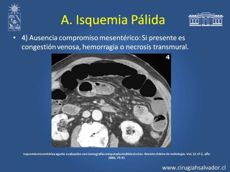 Diapositiva 15 de Isquemia Mesentérica