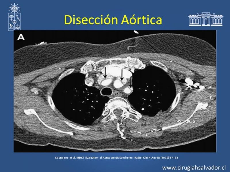 Diapositiva 13 de Sindrome Aórtico Agudo (SAA)