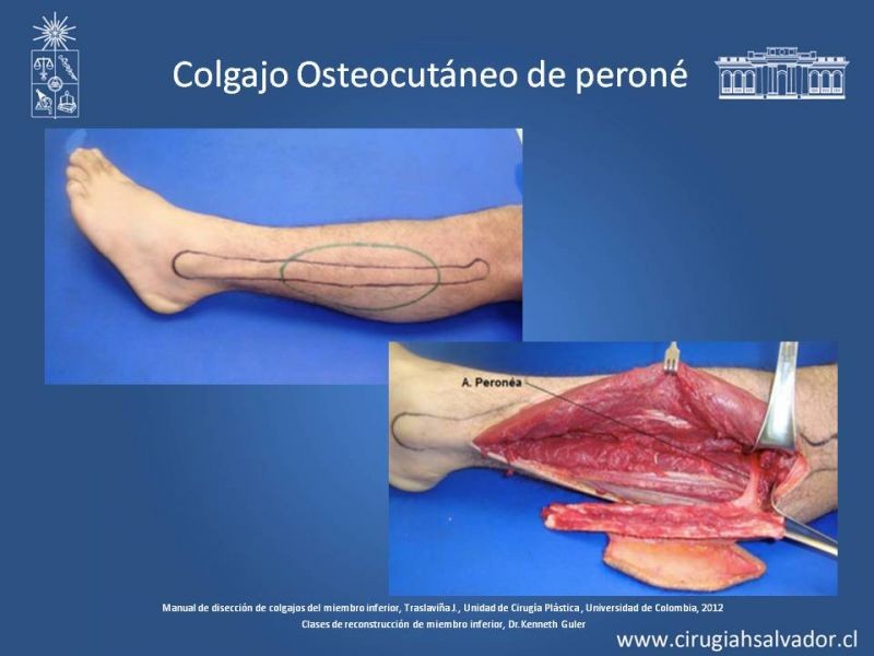 Diapositiva 34 de Cobertura de miembro inferior