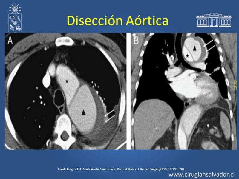 Diapositiva 12 de Sindrome Aórtico Agudo (SAA)