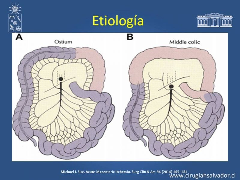 Diapositiva 6 de Isquemia Mesentérica
