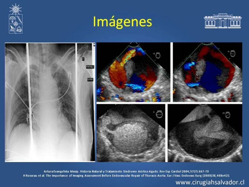 Diapositiva 6 de Sindrome Aórtico Agudo (SAA)