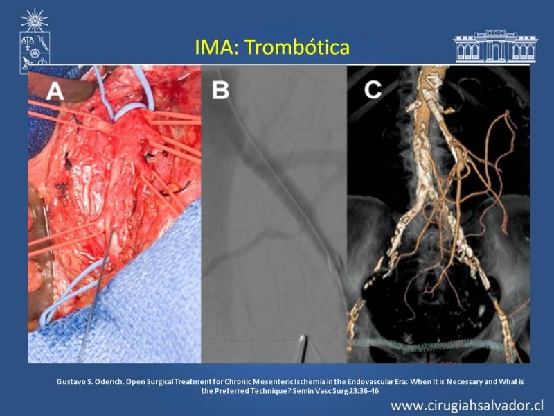 Diapositiva 37 de Isquemia Mesentérica
