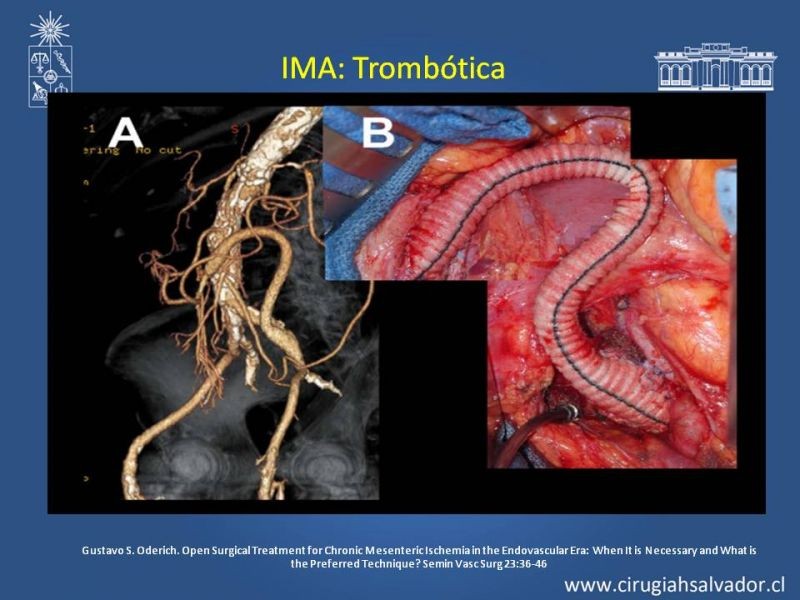 Diapositiva 35 de Isquemia Mesentérica