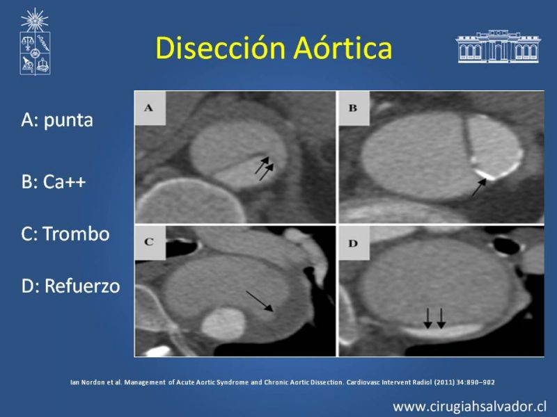 Diapositiva 10 de Sindrome Aórtico Agudo (SAA)