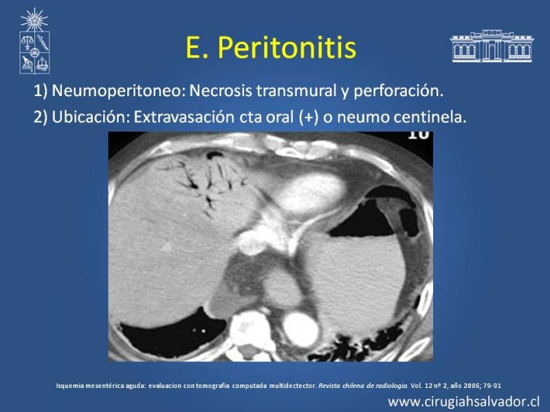 Diapositiva 22 de Isquemia Mesentérica