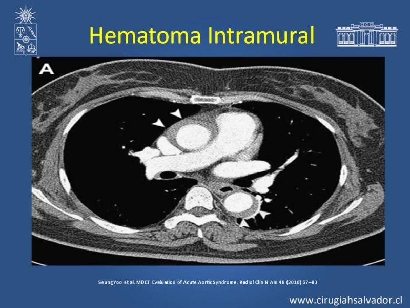 Diapositiva 20 de Sindrome Aórtico Agudo (SAA)