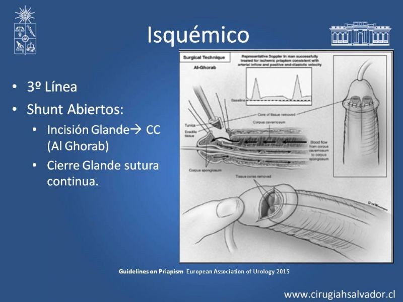 Diapositiva 22 de Priapismo