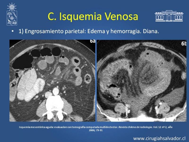 Diapositiva 18 de Isquemia Mesentérica