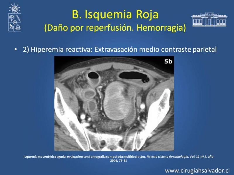 Diapositiva 17 de Isquemia Mesentérica