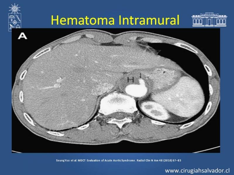 Diapositiva 22 de Sindrome Aórtico Agudo (SAA)