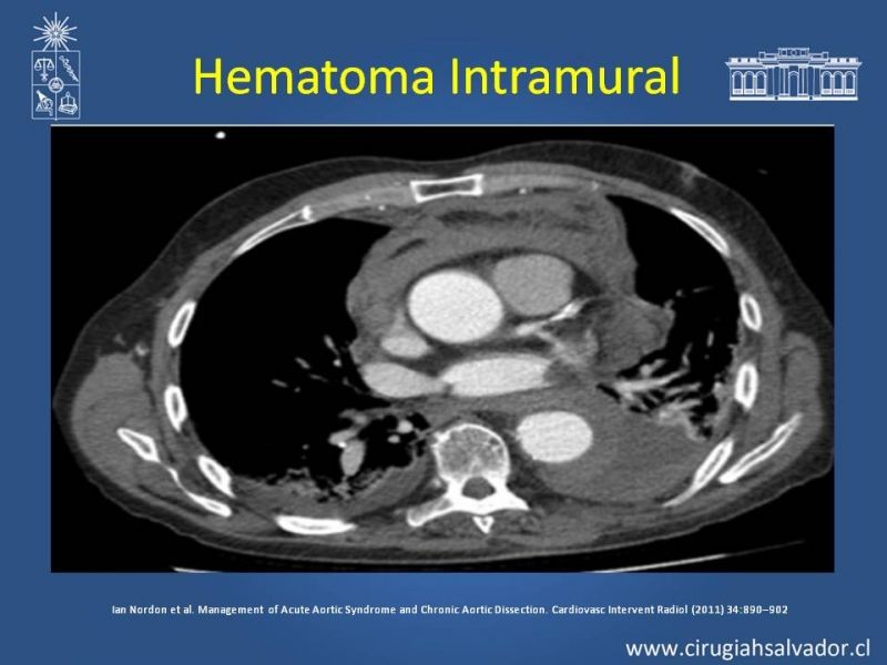 Diapositiva 19 de Sindrome Aórtico Agudo (SAA)