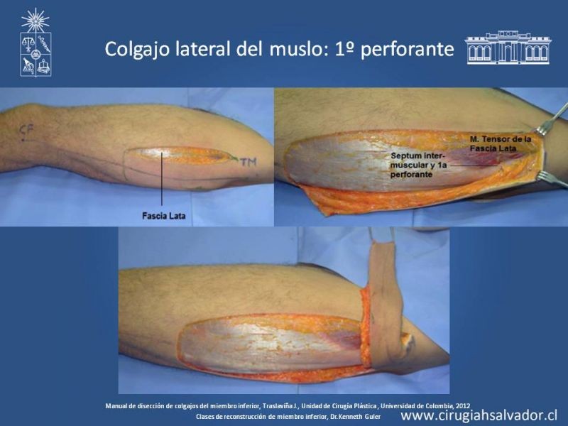 Diapositiva 21 de Cobertura de miembro inferior