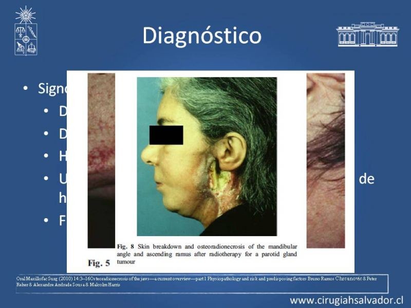 Diapositiva 9 de Osteoradionecrosis