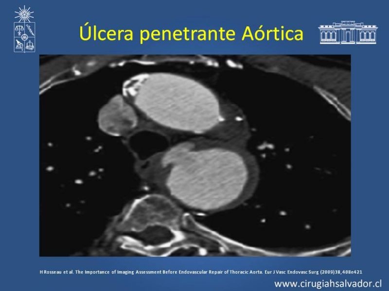 Diapositiva 27 de Sindrome Aórtico Agudo (SAA)