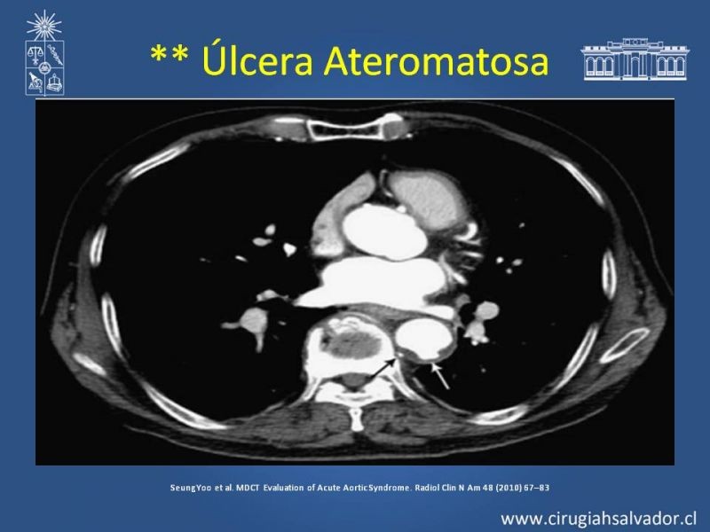 Diapositiva 26 de Sindrome Aórtico Agudo (SAA)