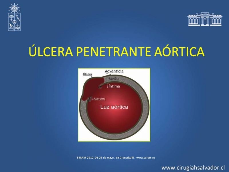 Diapositiva 24 de Sindrome Aórtico Agudo (SAA)