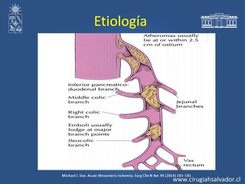 Diapositiva 5 de Isquemia Mesentérica