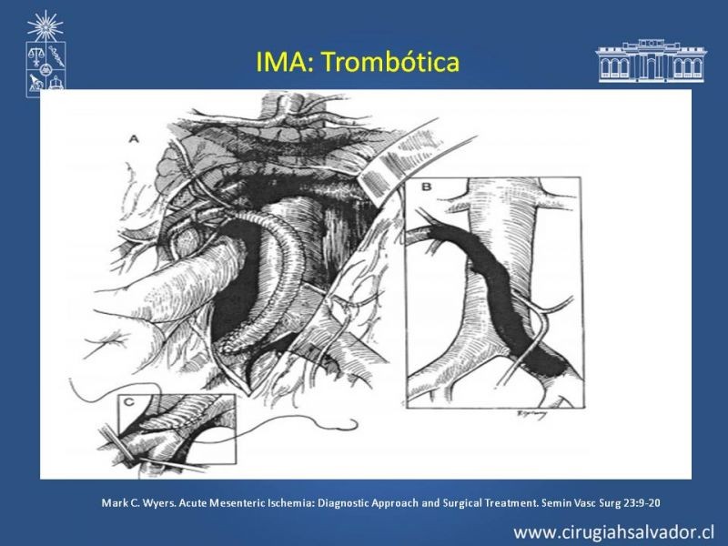Diapositiva 34 de Isquemia Mesentérica