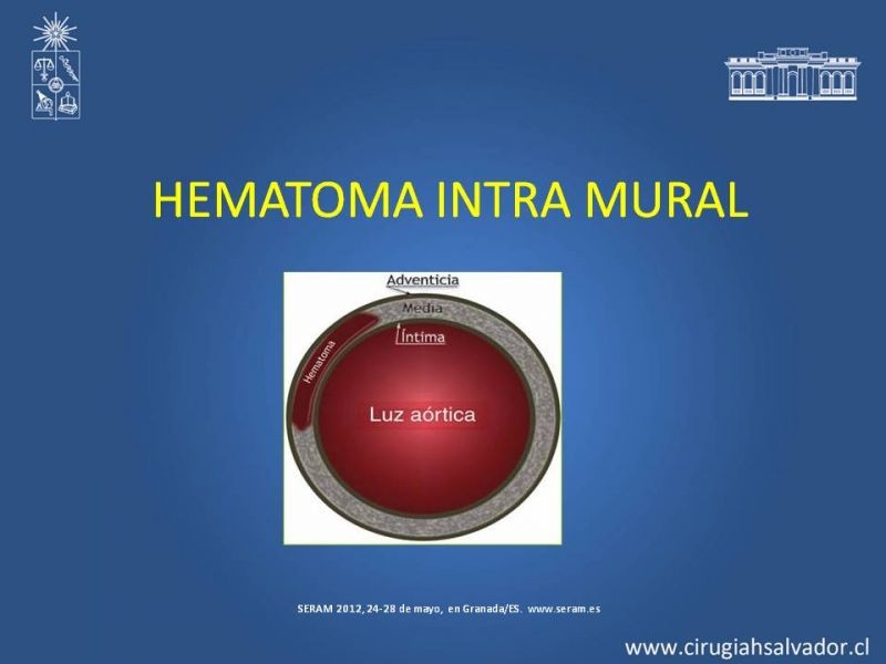 Diapositiva 17 de Sindrome Aórtico Agudo (SAA)
