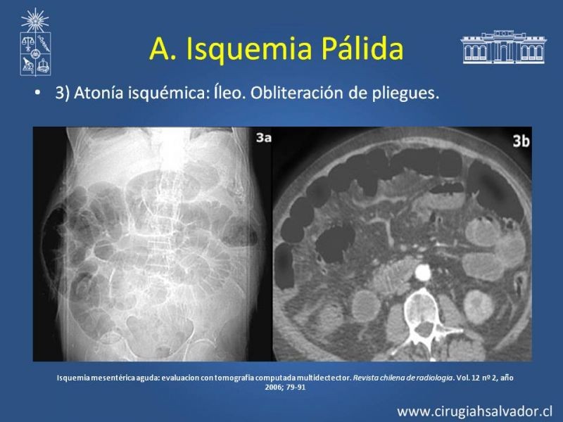 Diapositiva 14 de Isquemia Mesentérica