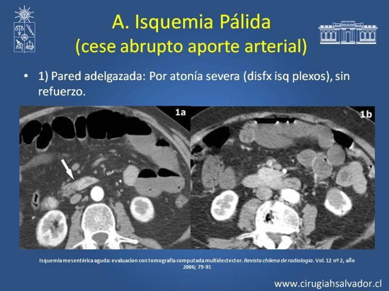 Diapositiva 12 de Isquemia Mesentérica