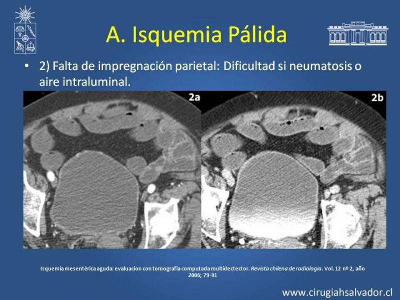 Diapositiva 13 de Isquemia Mesentérica