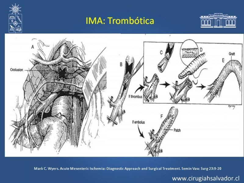 Diapositiva 31 de Isquemia Mesentérica