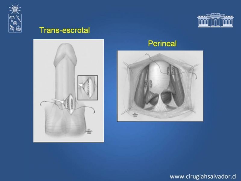 Diapositiva 24 de Priapismo