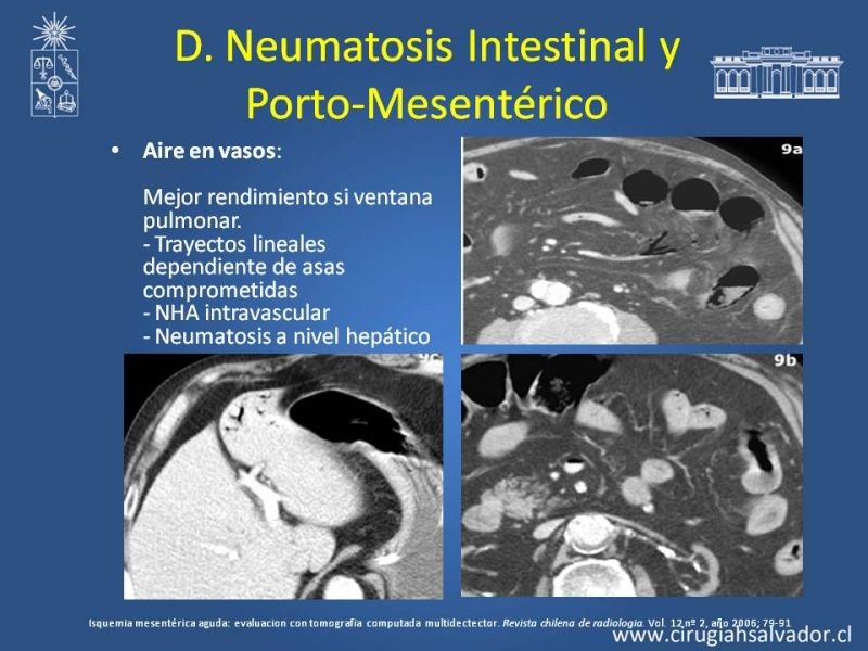 Diapositiva 21 de Isquemia Mesentérica