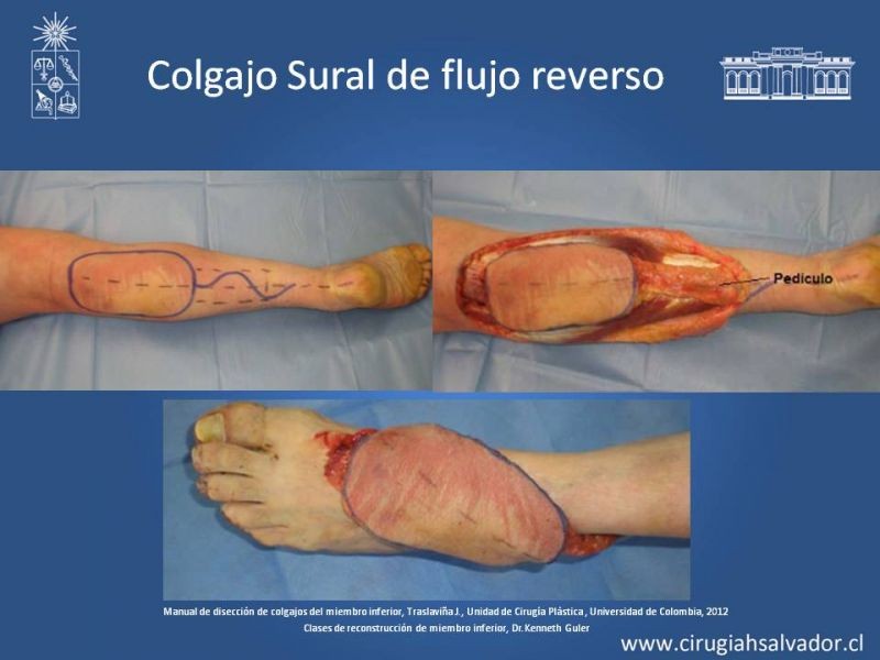 Diapositiva 42 de Cobertura de miembro inferior