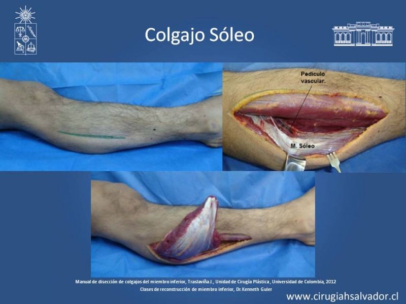 Diapositiva 38 de Cobertura de miembro inferior