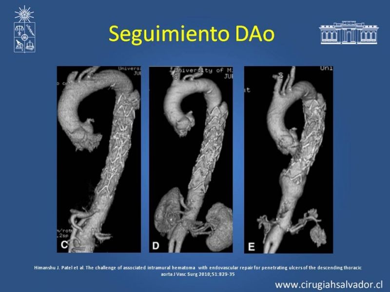 Diapositiva 38 de Sindrome Aórtico Agudo (SAA)