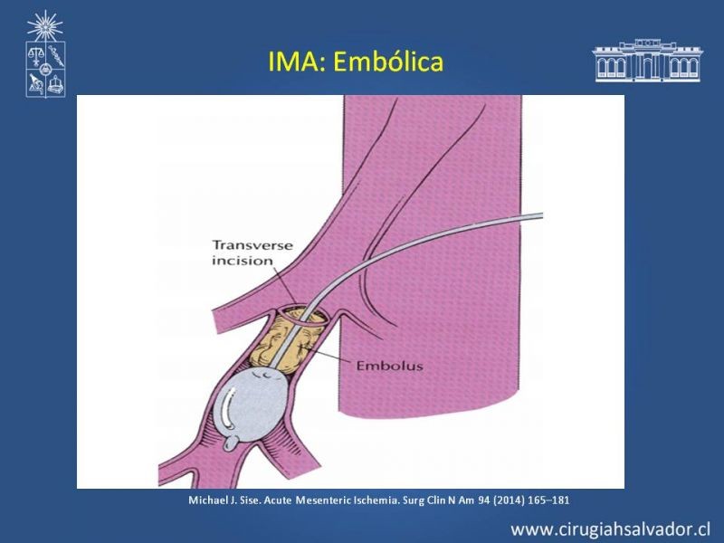 Diapositiva 29 de Isquemia Mesentérica