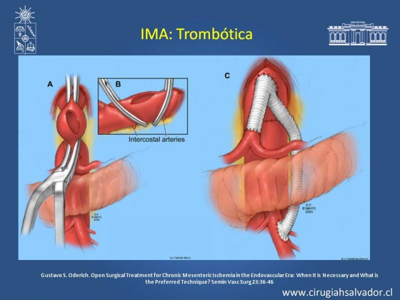 Diapositiva 32 de Isquemia Mesentérica