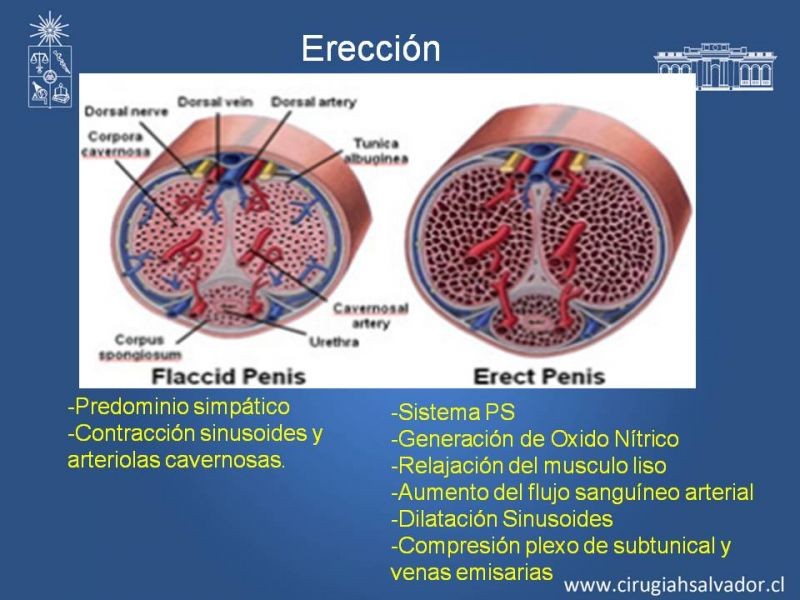 Diapositiva 3 de Priapismo