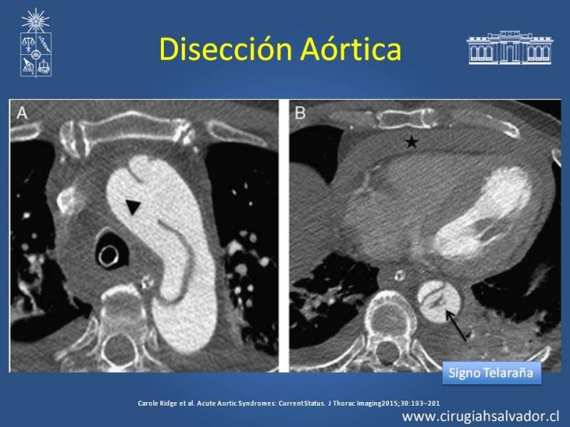 Diapositiva 11 de Sindrome Aórtico Agudo (SAA)